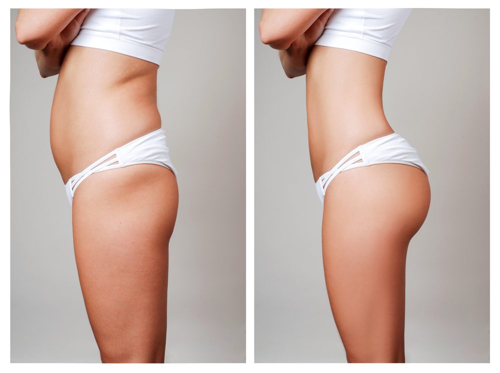 How to Get a Fat Transfer | Life360 Tips