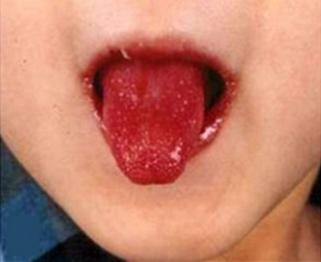 strawberry tongue